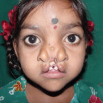 About Us Future Faces Training And Support Of Cleft Lip Palate