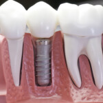 Dental Implant Placement Basics As A Step by Step Process General