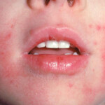 Eczema In Children National Eczema Association