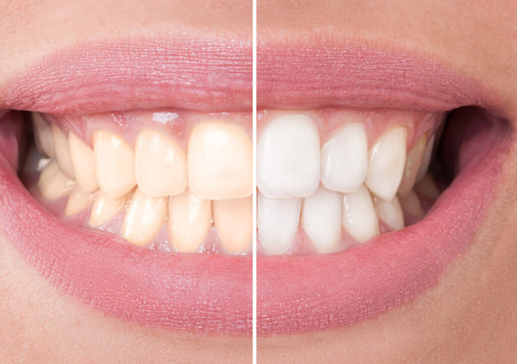 Teeth Whitening Ozark MO Opalescence Go Zoom Laser Whitening