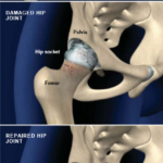 Total Hip Replacement Anterior Approach Central Coast Orthopedic