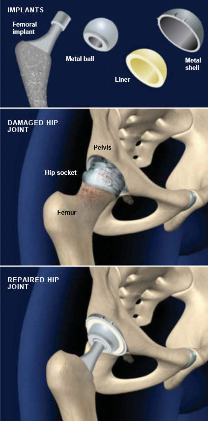 Total Hip Replacement Anterior Approach Central Coast Orthopedic 