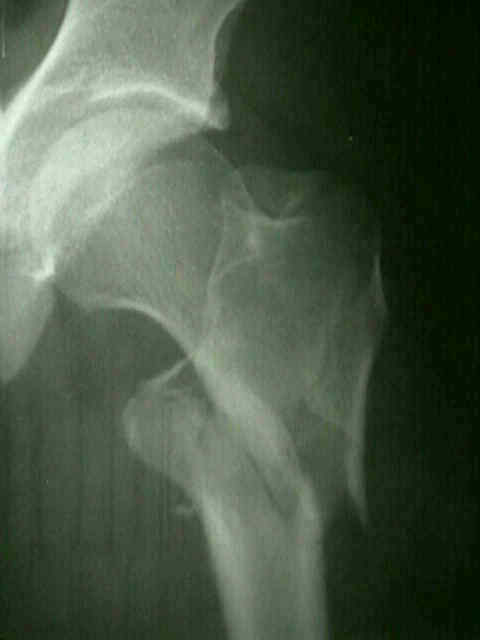 Type IV Intertrochanteric Fractures Wheeless Textbook Of Orthopaedics