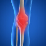 What Is Osteoarthritis